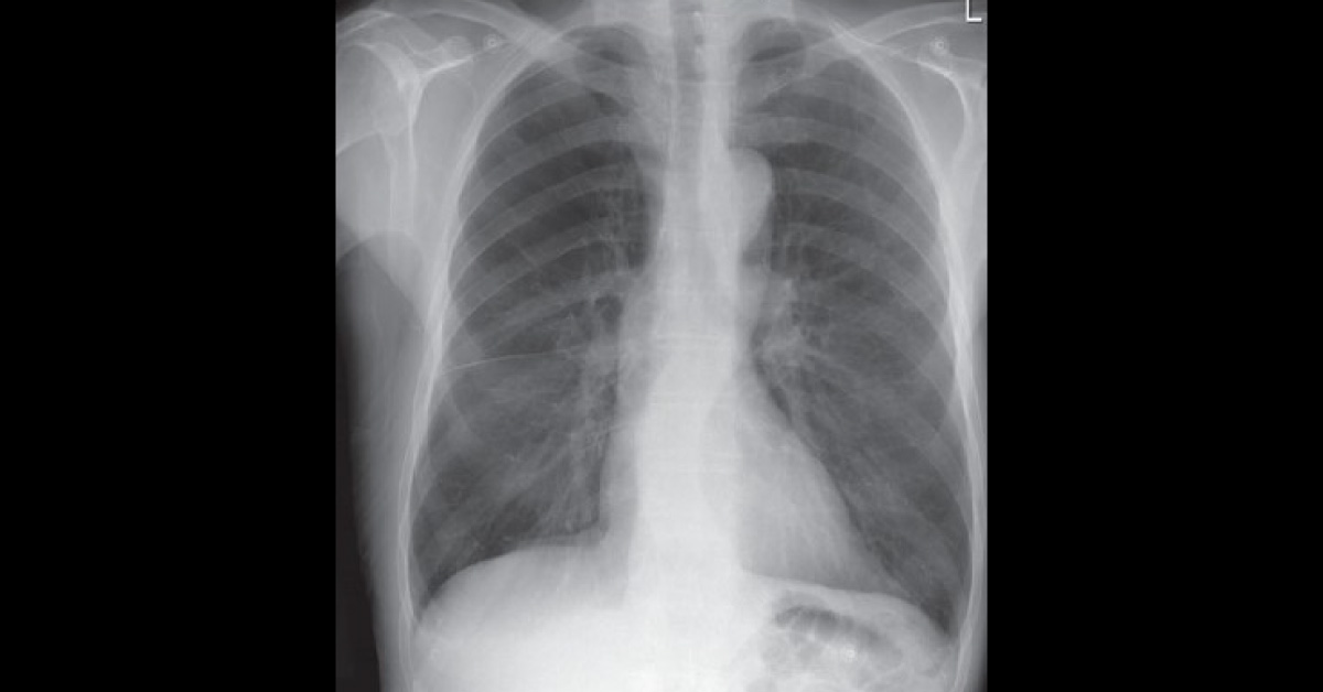Breathing Problem In A 72-Year-Old Smoker